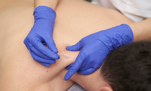 Aiguilles Dry Needling pour kinésithérapeutes