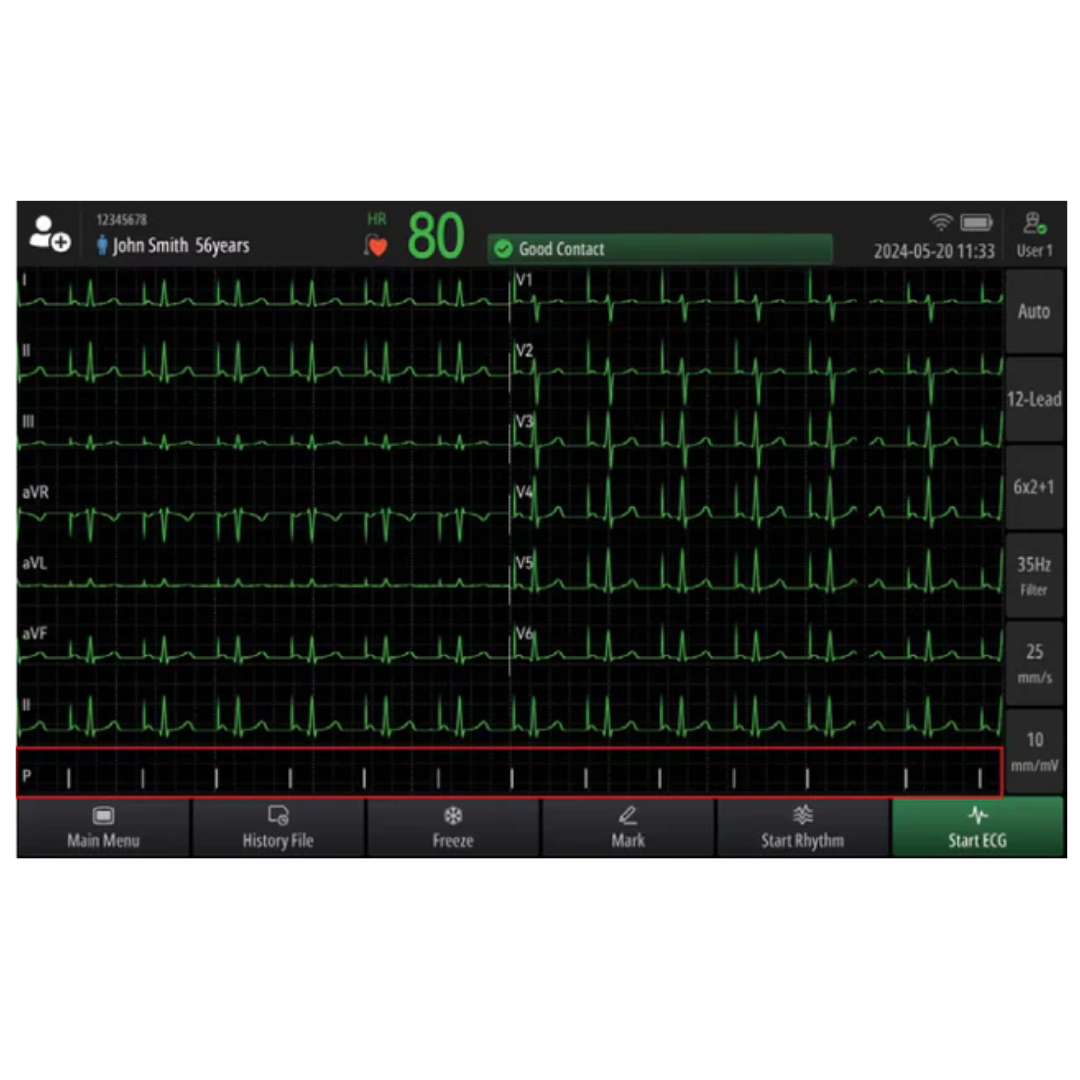 BeneHeart R700 Mindray : ECG professionnel 12 dérivations