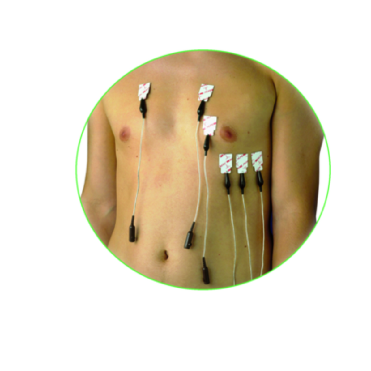 Electrodes 3M 2330  Red Dot - le sachet de 100 PCS